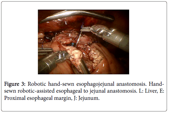 gastrointestinal-digestive-hand-sewn-esophagojejunal