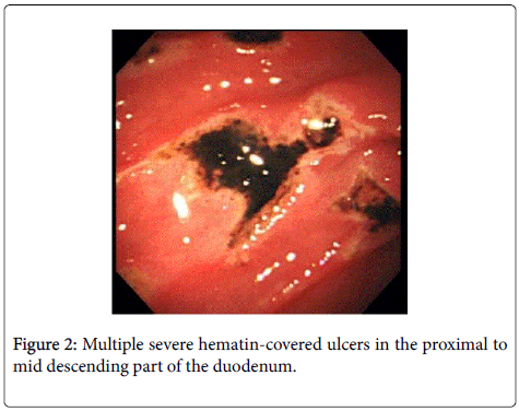 gastrointestinal-digestive-hematin-covered