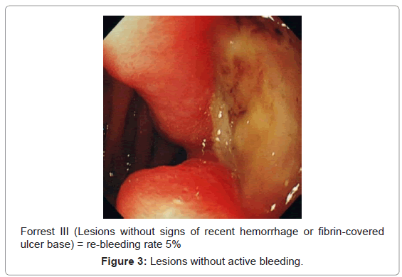 gastrointestinal-digestive-hemorrhage-fibrin-covered
