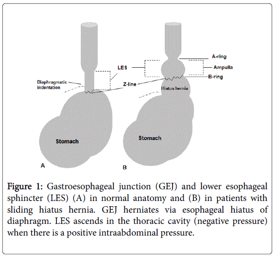 Hiatal Hernia Size Chart