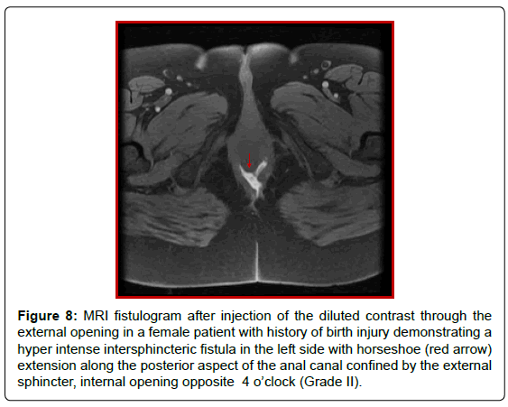 gastrointestinal-digestive-hyper-intense-intersphincteric