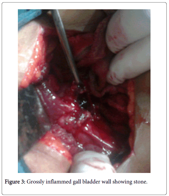 gastrointestinal-digestive-inflammed-gall-bladder