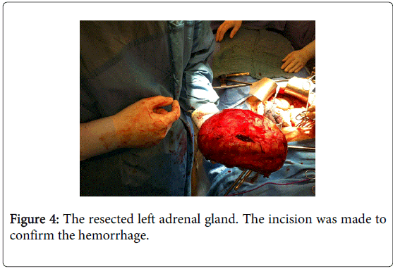 gastrointestinal-digestive-left-adrenal-gland
