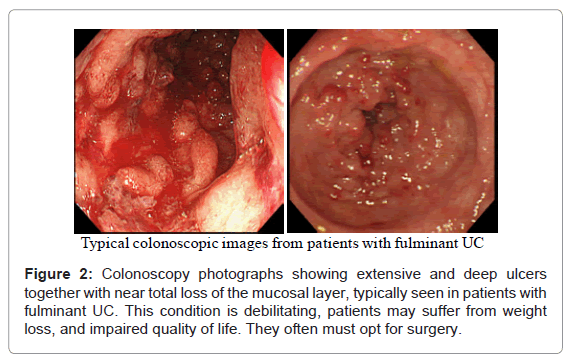 gastrointestinal-digestive-loss-mucosal-layer