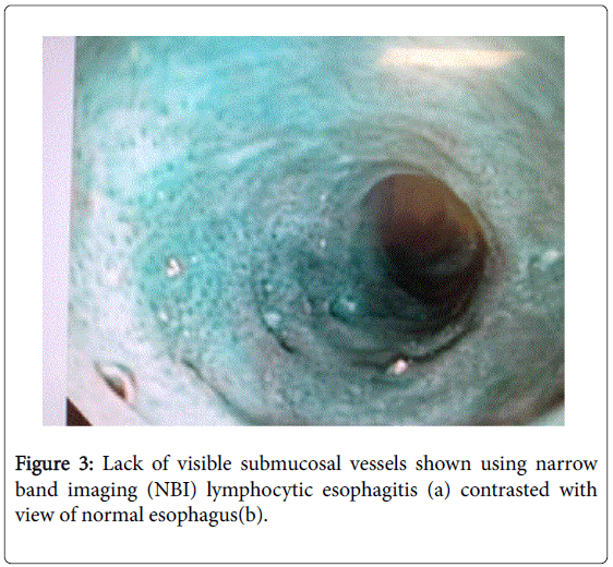 gastrointestinal-digestive-lymphocytic-esophagitis