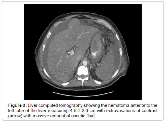 gastrointestinal-digestive-massive-ascetic-fluid