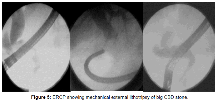 gastrointestinal-digestive-mechanical-external-lithotripsy