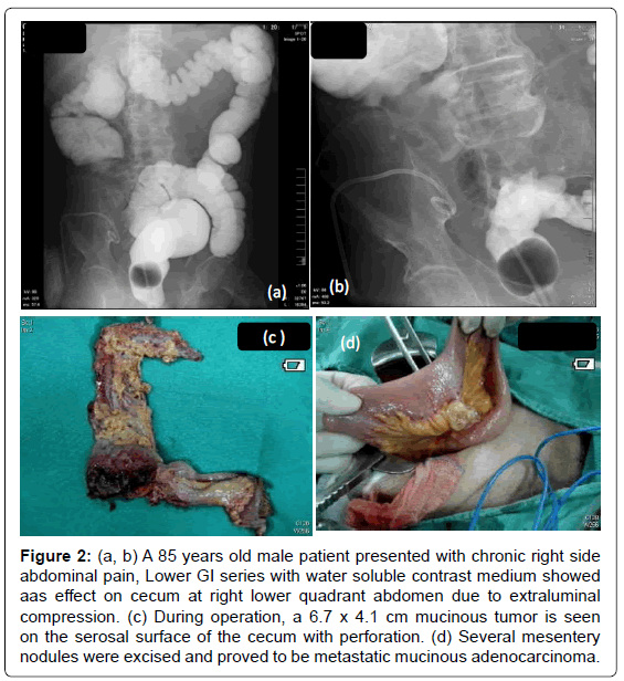gastrointestinal-digestive-mucinous-adenocarcinoma