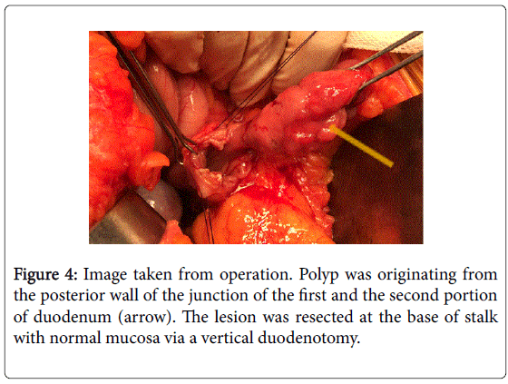 gastrointestinal-digestive-mucosa-vertical-duodenotomy