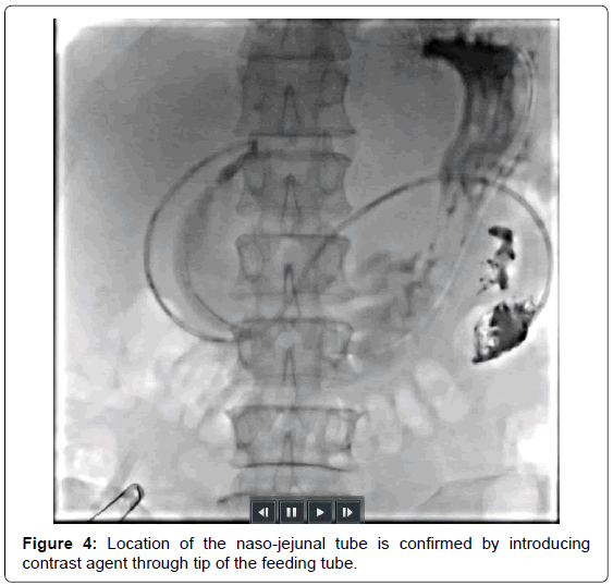 gastrointestinal-digestive-naso-jejunal-tube