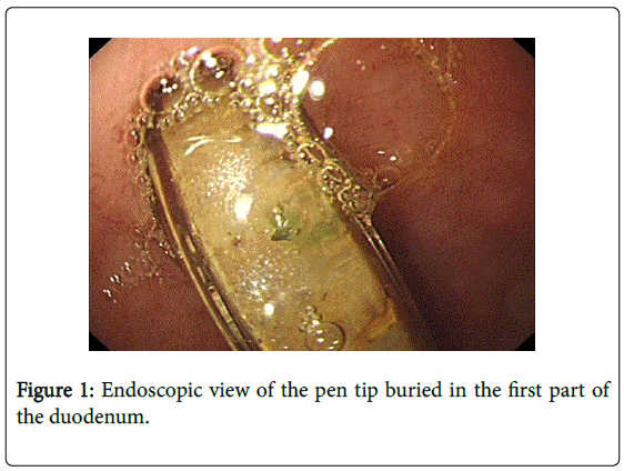 gastrointestinal-digestive-pen-tip-buried
