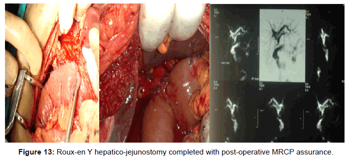 gastrointestinal-digestive-post-operative-MRCP