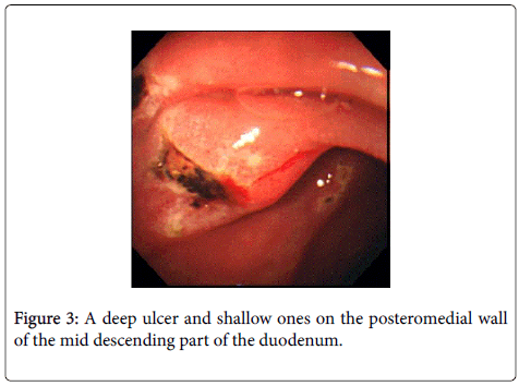 gastrointestinal-digestive-posteromedial-wall