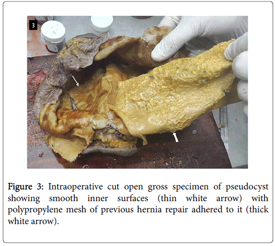 gastrointestinal-digestive-previous-hernia-repair