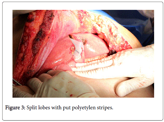 gastrointestinal-digestive-put-polyetylen-stripes