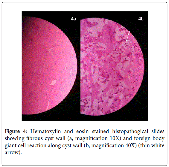 gastrointestinal-digestive-reaction-along-cyst