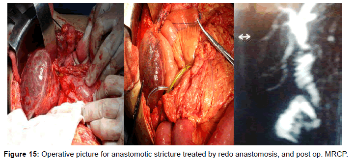 gastrointestinal-digestive-redo-anastomosis