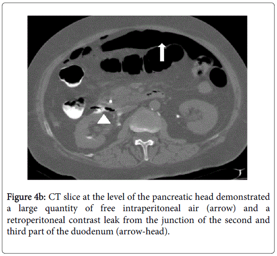 gastrointestinal-digestive-retroperitoneal-contrast-leak