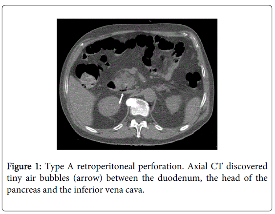 gastrointestinal-digestive-retroperitoneal-perforation