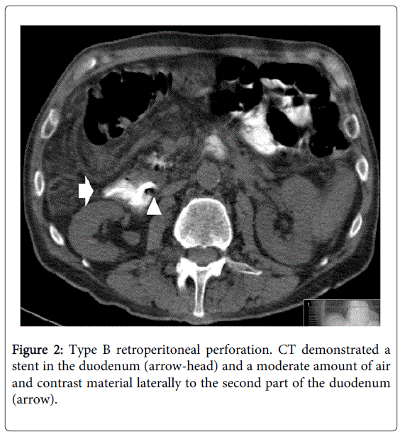 gastrointestinal-digestive-retroperitoneal-perforation