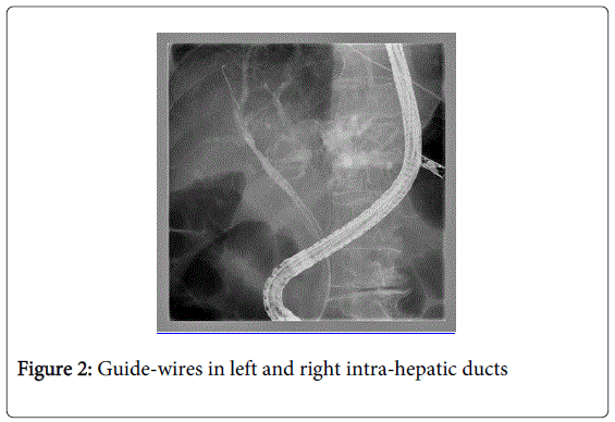 gastrointestinal-digestive-right-intra-hepatic-ducts