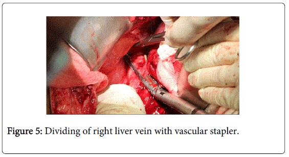 gastrointestinal-digestive-right-liver-vein