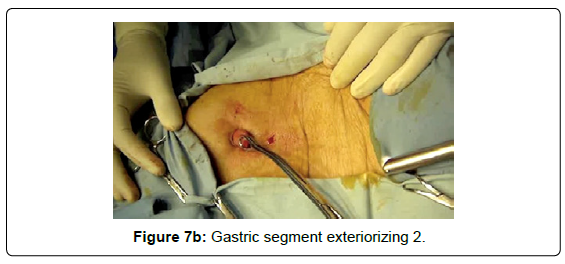 gastrointestinal-digestive-segment-exteriorizing