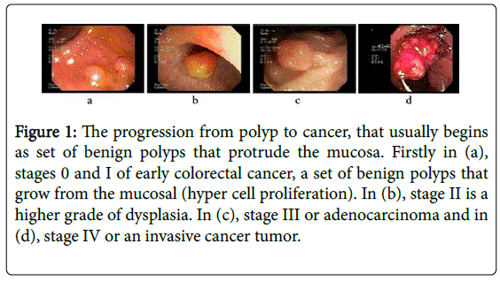 gastrointestinal-digestive-set-benign-polyps