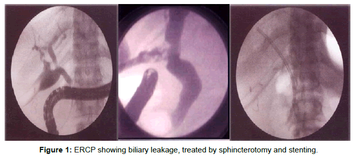 gastrointestinal-digestive-showing-biliary-leakage