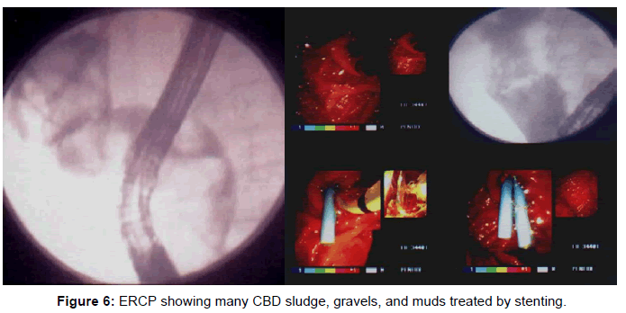 gastrointestinal-digestive-sludge-gravels-muds
