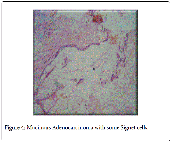 gastrointestinal-digestive-some-Signet-cells