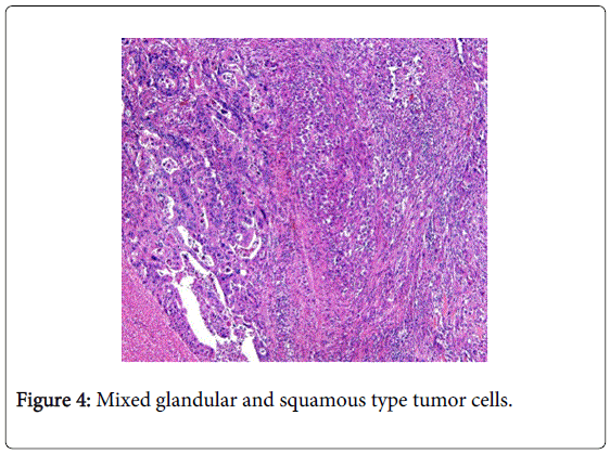 gastrointestinal-digestive-squamous-tumor-cells