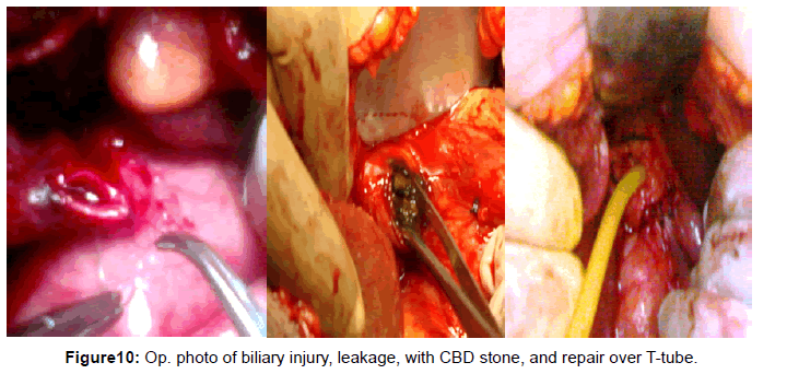 gastrointestinal-digestive-stone-repair-over-T-tube