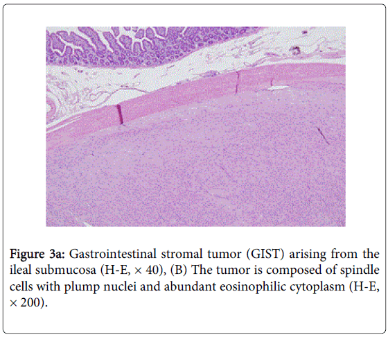 gastrointestinal-digestive-stromal-tumor-arising