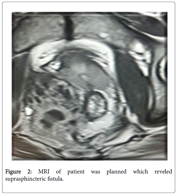 gastrointestinal-digestive-suprasphincteric-fistula