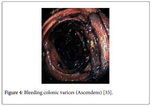 gastrointestinal-digestive-system-Bleeding-colonic