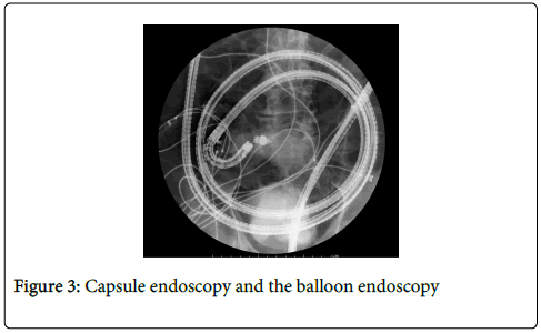 gastrointestinal-digestive-system-Capsule-endoscopy