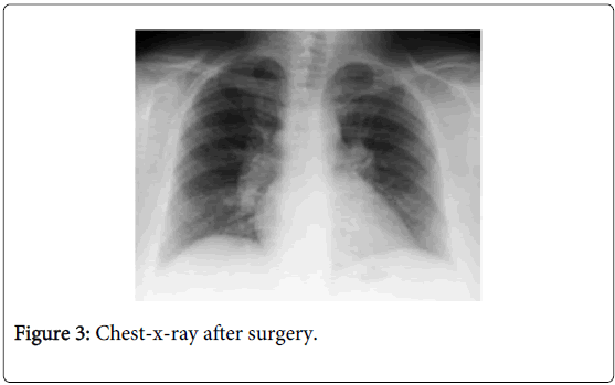 gastrointestinal-digestive-system-Chest-surgery