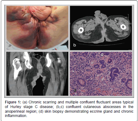 gastrointestinal-digestive-system-Chronic-scarring