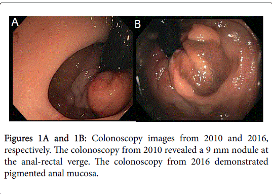 gastrointestinal-digestive-system-Colonoscopy