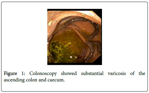 gastrointestinal-digestive-system-Colonoscopy-showed