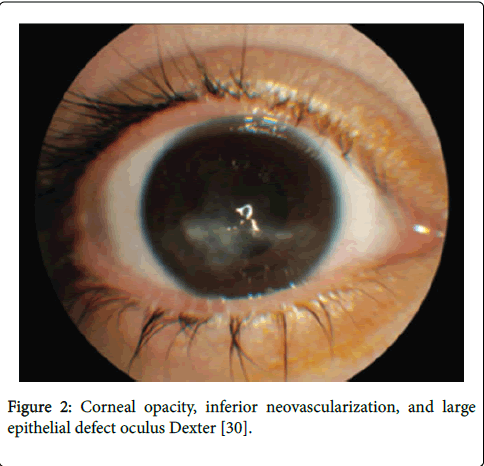 gastrointestinal-digestive-system-Corneal-opacity