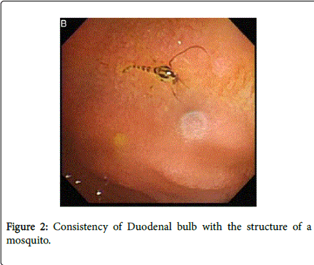 gastrointestinal-digestive-system-Duodenal-bulb