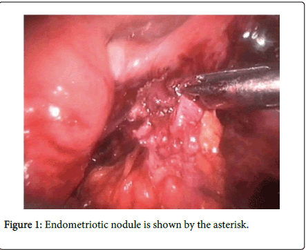 gastrointestinal-digestive-system-Endometriotic-nodule
