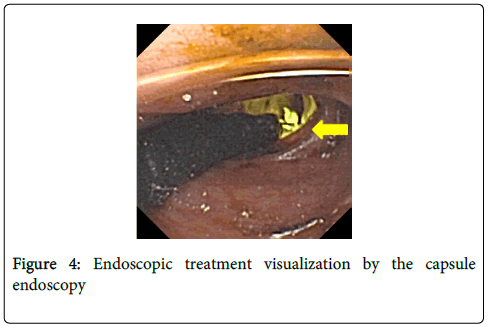 gastrointestinal-digestive-system-Endoscopic-treatment