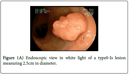 gastrointestinal-digestive-system-Endoscopic-view