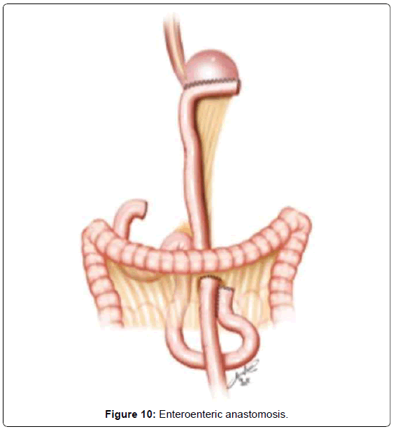 gastrointestinal-digestive-system-Enteroenteric-anastomosis