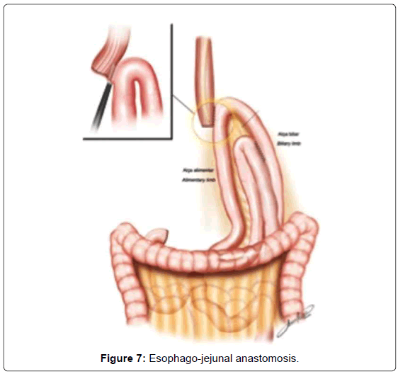 gastrointestinal-digestive-system-Esophago-jejunal