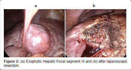 gastrointestinal-digestive-system-Exophytic-Hepatic