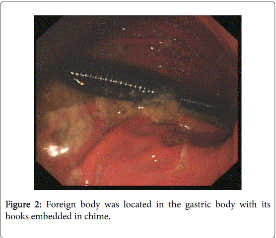 gastrointestinal-digestive-system-Foreign-body